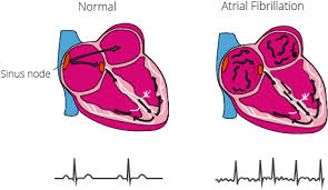 Atrial Fibrillation.jpg